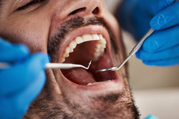 Best Emergency Dentist for Lost Fillings or Crowns in Chambersburg, PA